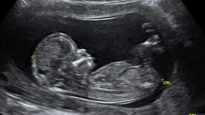 Ecografía de un feto en la semana 18 de embarazo
